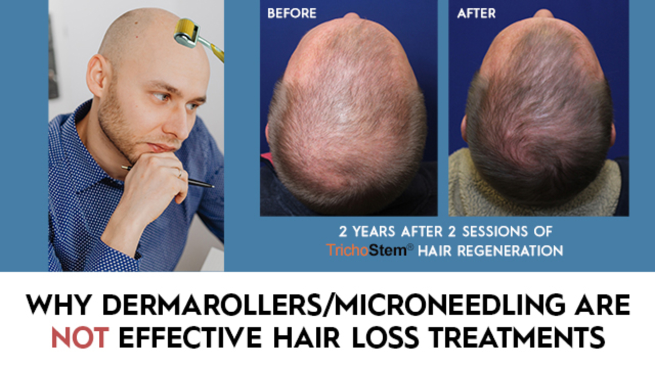 Why Scalp Microneedling/ Dermarollers Have Limited Benefits in Pattern ...