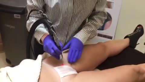 Bikini Laser Hair Removal Video RealSelf