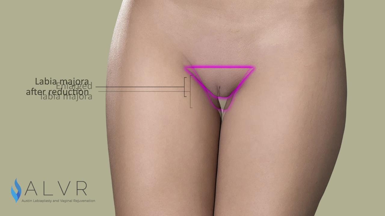 Mons Pubis Reduction Before & After Animation - Video - RealSelf