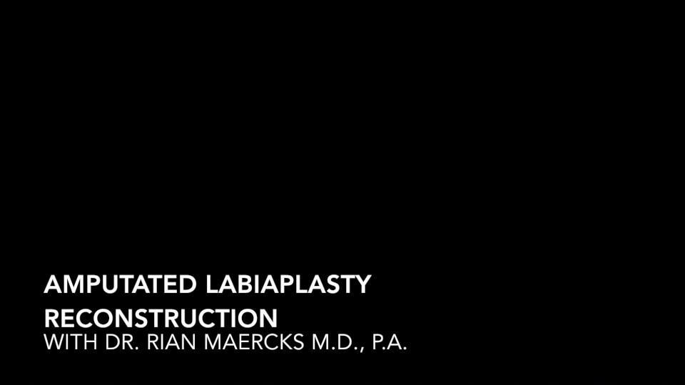 Amputated Edge Trim Labiaplasty Reconstruction Graphic Video 4552
