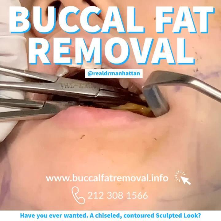 Buccal Fat Pad Removal Graphic Video Realself