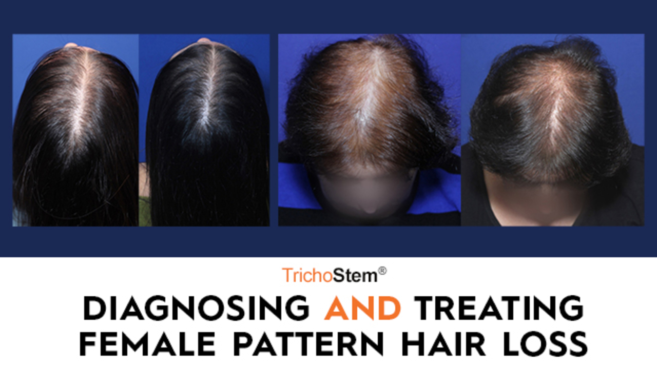 Diagnosing And Treating Female Pattern Hair Loss - Video - RealSelf