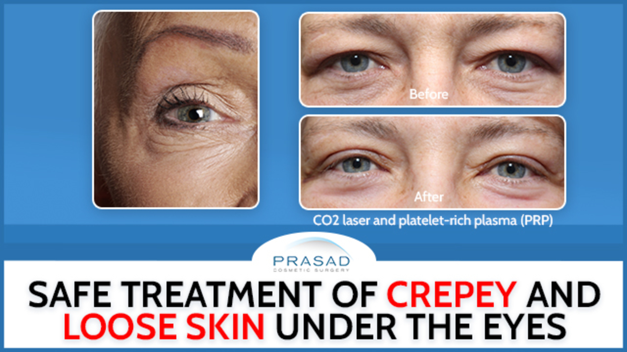 Treating Loose and Crepey Skin Under the Eyes Safely - Video - RealSelf