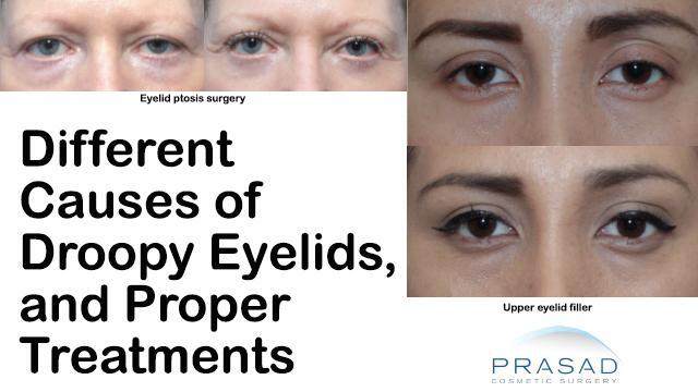 Different Causes for the Appearance of Droopy Eyelids, and Appropriate ...