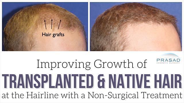 Factors of Frontal Hair Transplant Growth, Improvement, and Coverage ...