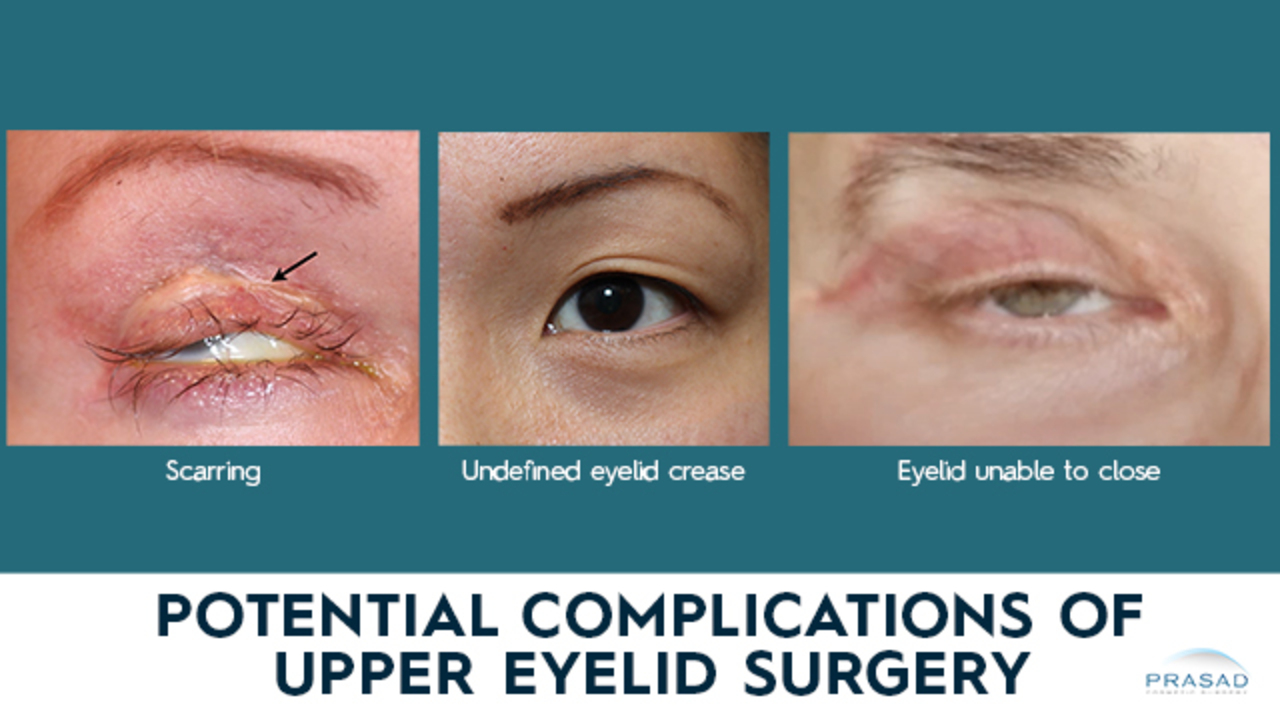 Treating Concurrent Under Eye Puffiness and Hollowness - Prasad Cosmetic  Surgery