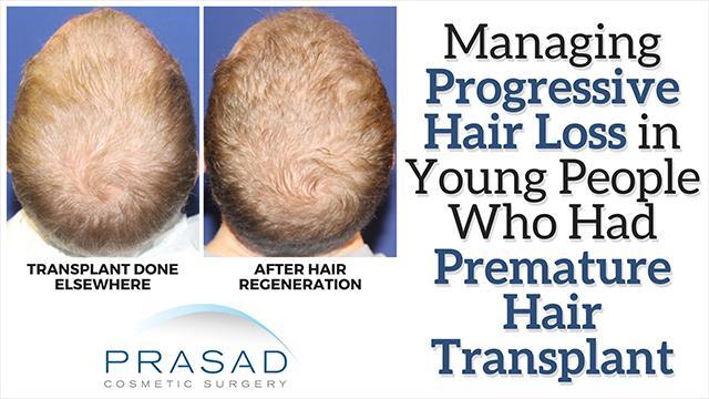 Managing Aggressive Hair Loss After Premature Hair Transplants - Video ...