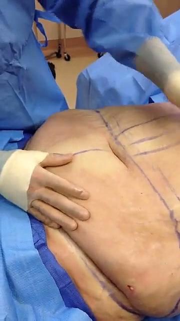 Plus-Size Tummy Tuck Using Fleur de Lis Pattern (GRAPHIC) - Video - RealSelf