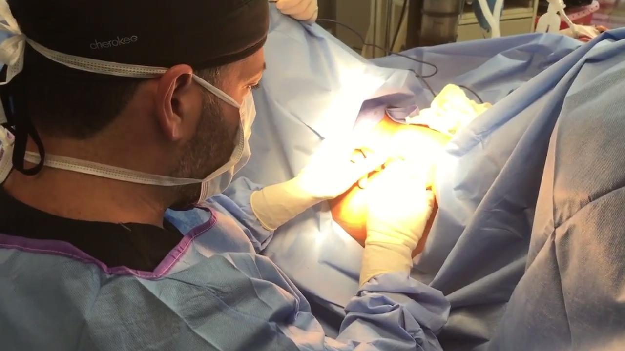 Labiaplasty & Clitoral Hood Reduction (GRAPHIC) - Video - RealSelf
