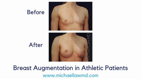 Breast Augmentation in Athletic Patients - Video - RealSelf