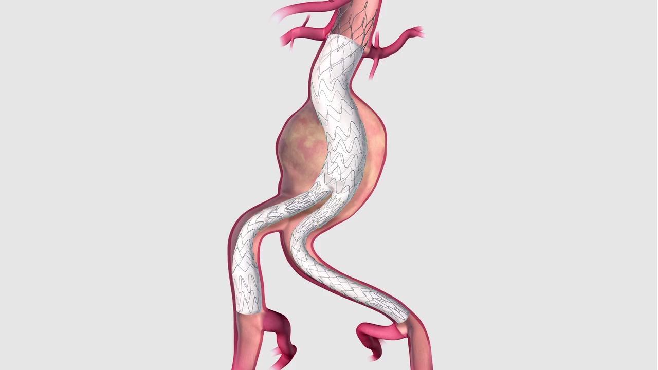 大人 可愛い 服  Zenith Alpha™ Spiral-Z® Endovascular Leg | Cook Medical 医学一般