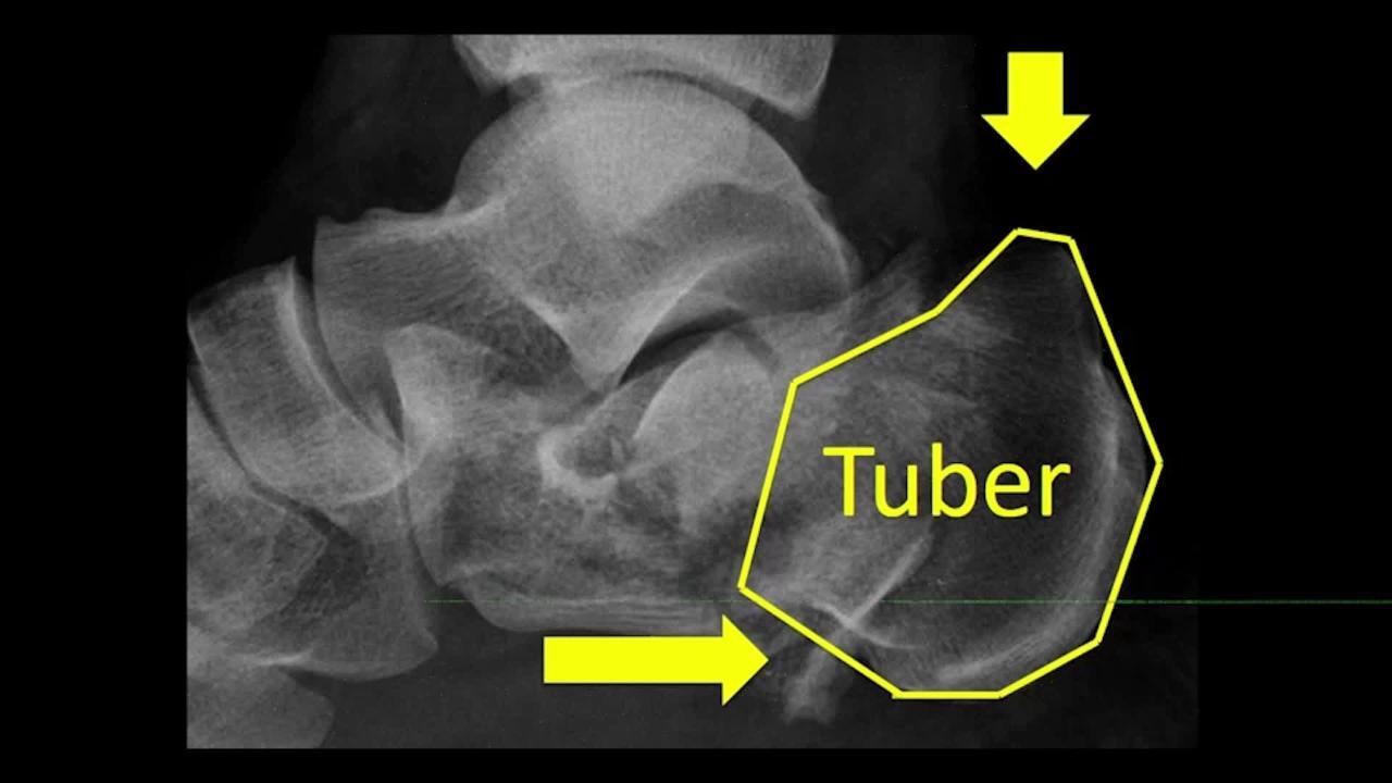 Talus Fractures: When Do I Take These to the OR?