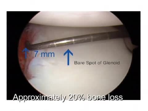 The Recognition, Measurement, and Arthroscopic Treatment of Patients with Glenoid Bone Loss