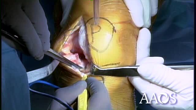 Medial Uni-Condylar Arthroplasty Exposure