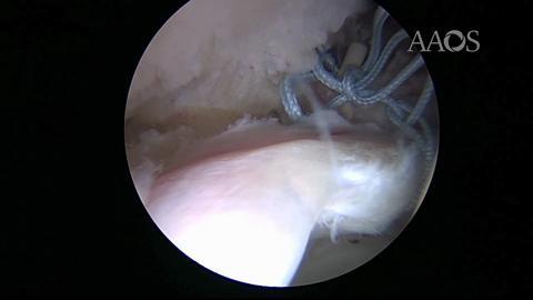 Hip Arthroscopy and Periacetabular Osteotomy Treatment of Acetabular Dysplasia and Associated Labral Tear