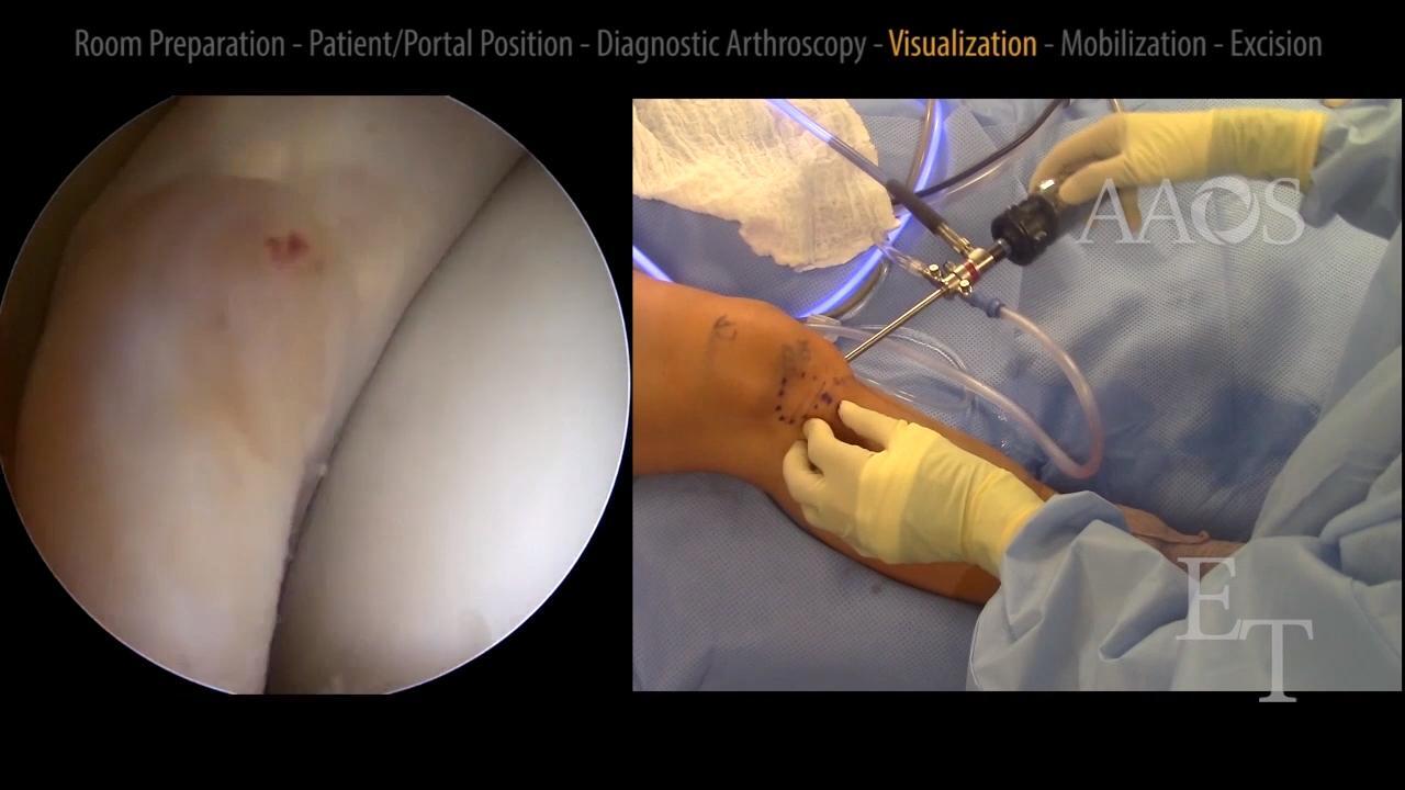 Arthroscopic Excision of Localized Pigmented Villonodular Synovitis of the Knee