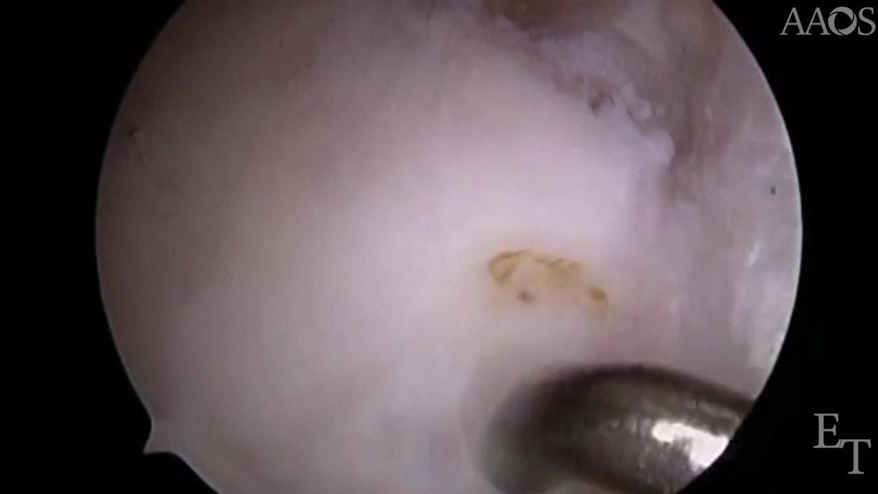 Lateral Meniscus Allograft Transplantation: The Bone Plug Technique