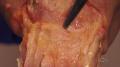 Anatomy, Pathology and Physical Examination of the Scapho-Lunate and Luno-Triquetral Joints