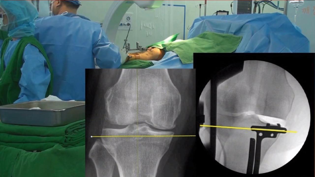 Usefulness of Fluoroscopy for Extramedullary Tibial Bone Cutting and Arthroscopy for Excess Cement Removal in Medial Unicompartmental Knee Arthroplasty