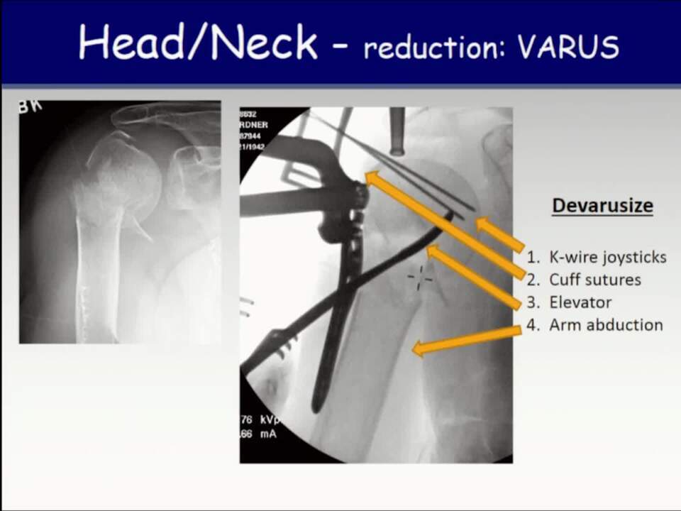 ORIF of Proximal Humerus Fractures: Tips, Tricks, & Approaches