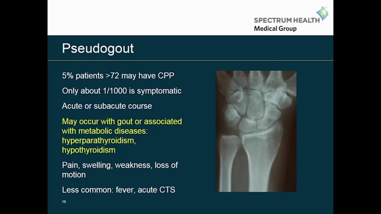 Gout and Pseudogout