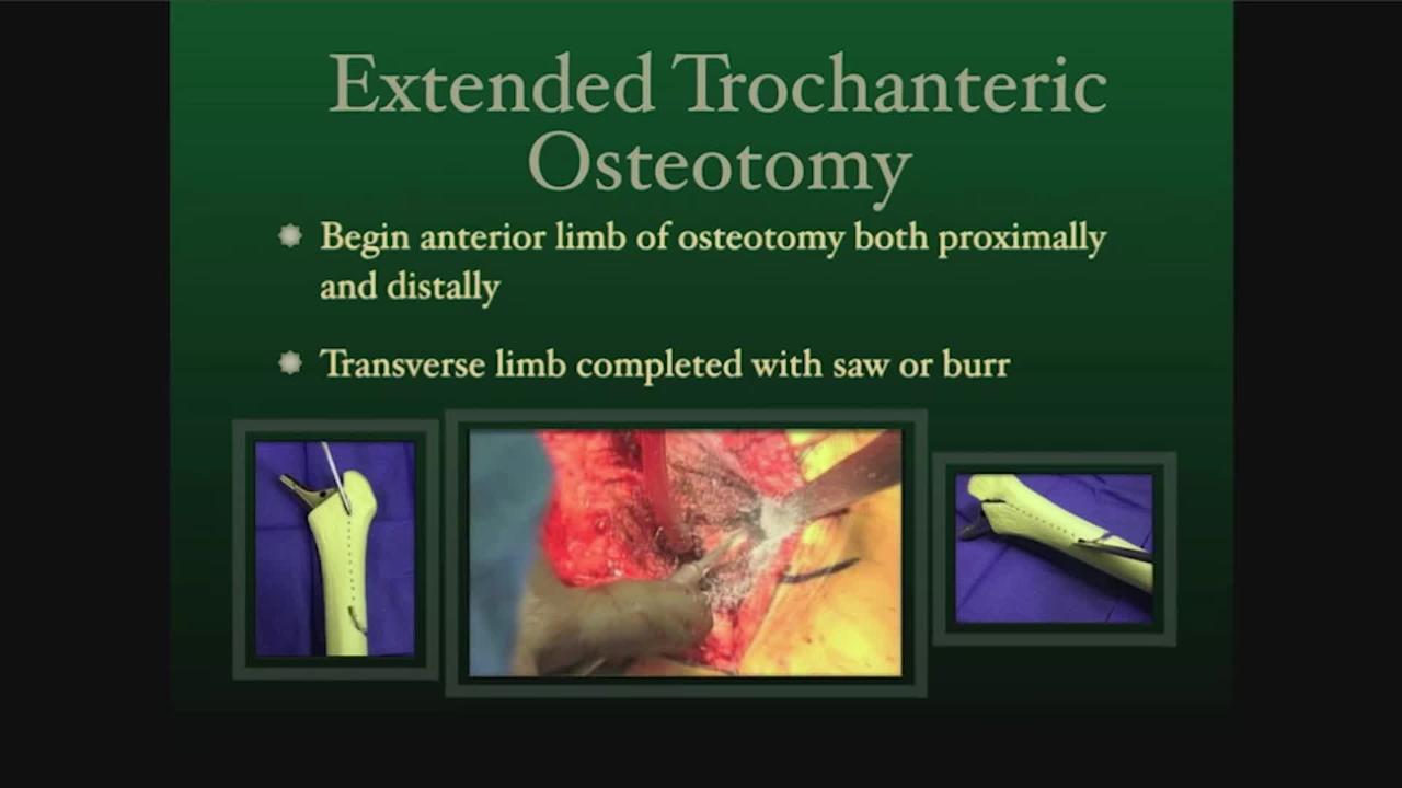 Why Struggle? Do an Extended Trochanteric Osteotomy
