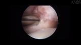 Syndesmotic Injuries: Physical Examination, Diagnosis, and Arthroscopic-Assisted Reduction