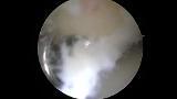 Ankle Impingement