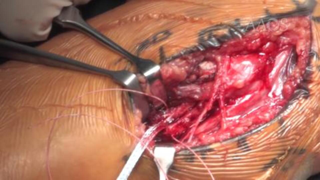 Thumb Ulnar Collateral Ligament Repair With Internal Brace Augmentation