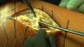 Minimally Invasvie Technique for Curettage of Benign Bone Tumors Using Endoscopic Technique