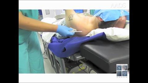 Use of Codman’s Paradox to Perform Safe and Simple Manipulation Under Anesthetic for Frozen Shoulder Release