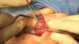 Sagittal Band Reconsruction for Chronic Extensor Tendon Dislocation