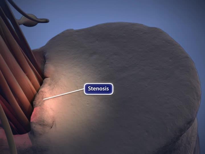 Lumbar Spinal Stenosis - OrthoInfo - AAOS