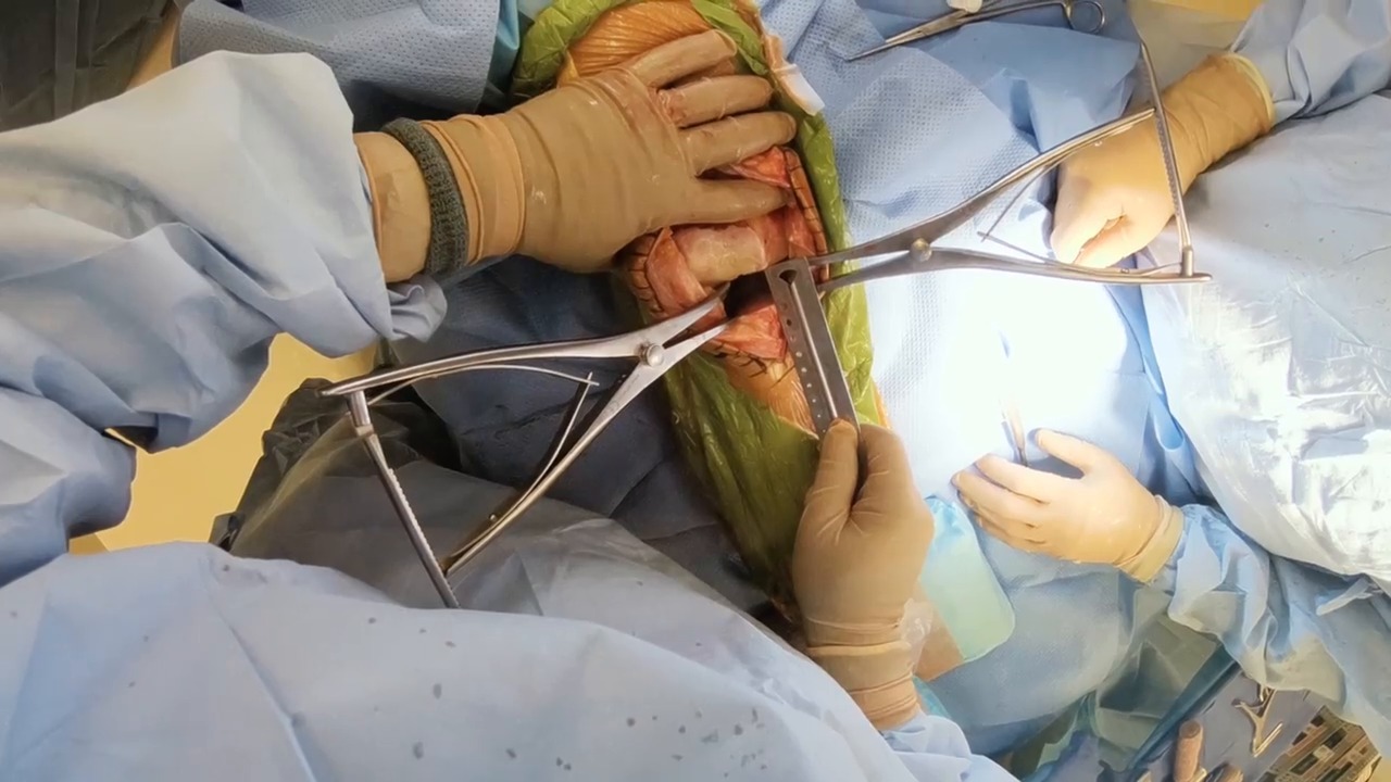 Mechanical Alignment and Gap Balancing in Total Knee Arthroplasty: Rationale and Technique