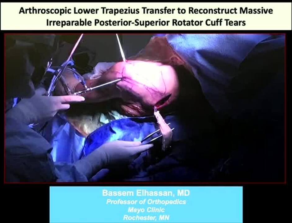 Arthroscopic Lower Trapezius Transfer to Reconstruct Massive Irreparable Posterior-Superior Rotator Cuff Tears
