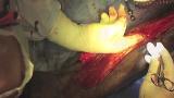 Reverse Sural Artery Flap Review and Technique