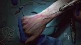 Metacarpal Fractures: Antegrade Intramedullary Headless Screw Fixation
