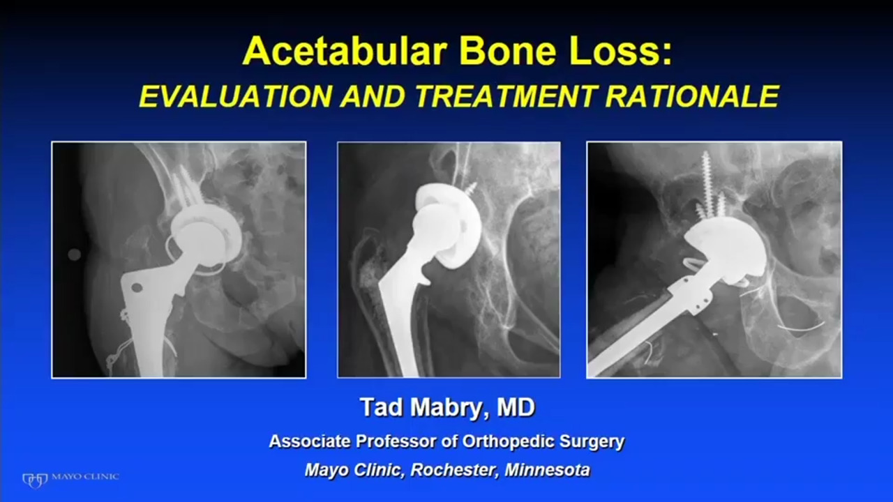 Acetabular Bone Loss- Evaluation and Treatment Rationale