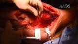 Radical Resection of a Pelvic Osteosarcoma