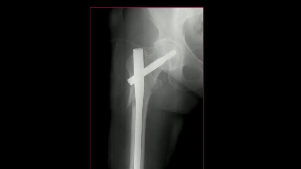 When Femoral Fracture Fixation Fails: Salvage Option