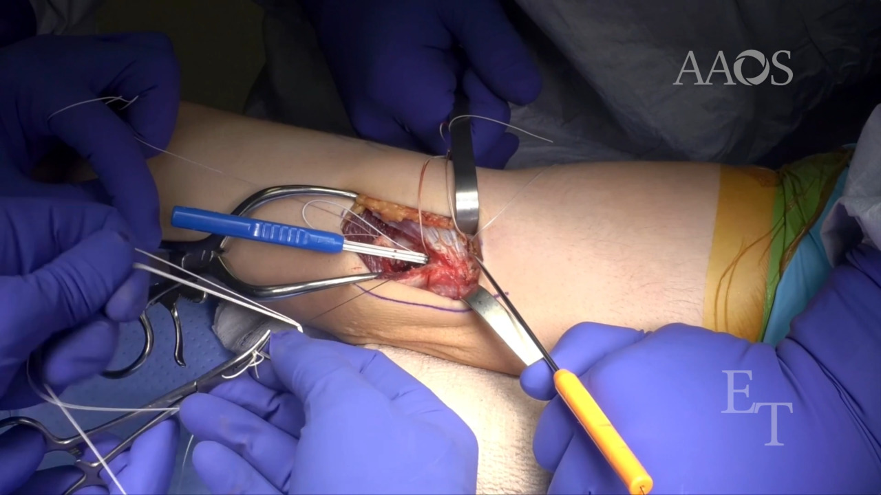 Medial Collateral Ligament Reconstruction Video