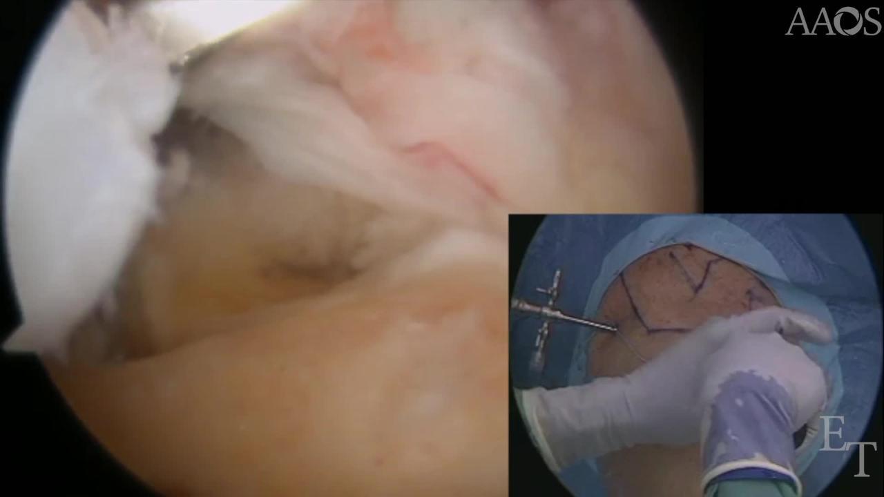 Arthroscopic Transosseous Revision Rotator Cuff Repair: A Surgical Video