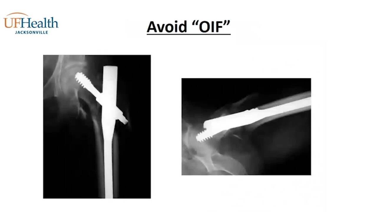 Reduction Tips for IMN of Hip Fractures