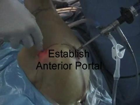 Arthroscopic Capsular Release: Keys to Safe and Effective Restoration of Motion