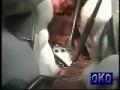 Thoracolumbar Burst Fractures: Anterior Decompression and Interbody Fusion