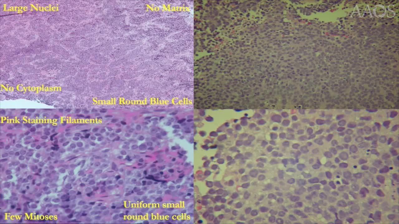 Small Round Blue Cell Tumors of Bone: An Interactive Review