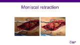 Traditional and Alternative Surgical Approaches to the Tibial Plateau