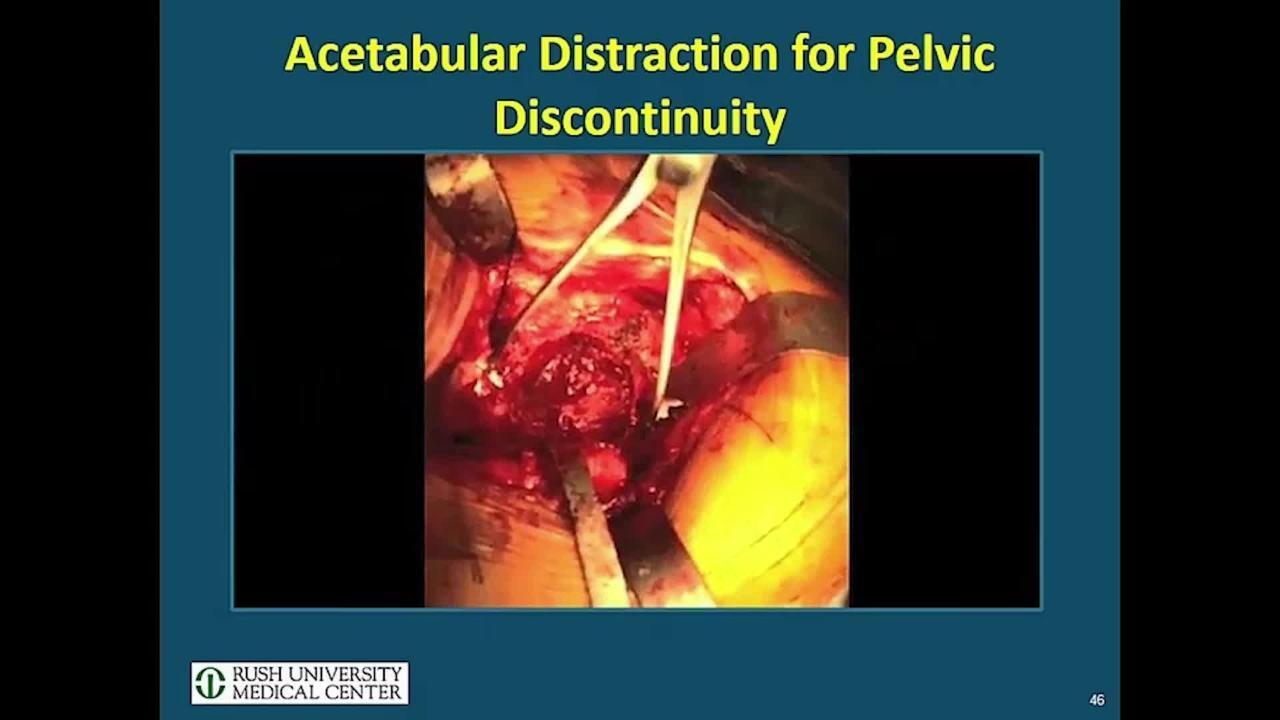 Pelvic Discontinuity and Bone Loss