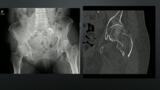 Total Hip Arthroplasty for Acute Intertronchanteric Fractures