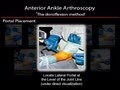 Arthroscopic Surgical Techniques: Advanced Ankle Arthroscopy - Set Up for Anterior Ankle Arthroscopy: Dorsiflexion Method Positioning, Portals and Diagnostic  Examination